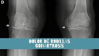 DOLOR DE RODILLAS Gonartrosis Osteoporosis MUJER DE 86 AÑOS [upl. by Janos]