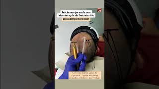 Mesoterapia Capilar Mesoterapia con Dutasteride para alopecia mesoterapia hair cabello salud [upl. by Mariano824]