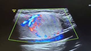 Ultrasound of hyperplastic adenomatous nodule in right lobe of thyroid [upl. by Drof]