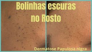 Como acabar com a Dermatose Papulosa Nigra Bolinhas escuras na pele nunca mais  Jato de Plasma [upl. by Annayram]