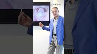 Eye Bag Removal Surgery Before amp After  Dr Bashar Bizrah LondonDubai 887 [upl. by Anny255]