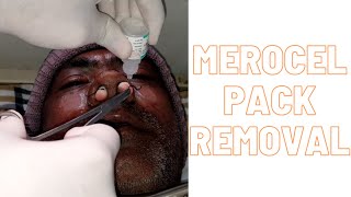 Merocel pack removal [upl. by Vite]