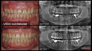 WORN DENTITION JIG for Deprogrammed Passively Retruded DPR Position Intra Oral Scanner and BOPT [upl. by Billi]