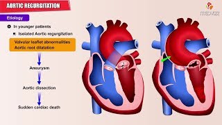 Aortic regurgitation  Aortic insufficiency  Etiology  Pathology  Diagnosis and Treatment USMLE [upl. by Ehudd732]