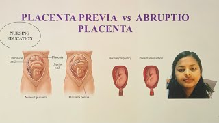 PLACENTA PREVIA VS ABRUPTIO PLACENTA FOR NCLEX EXAM AND NURSES USRN USNURSE [upl. by Martres]