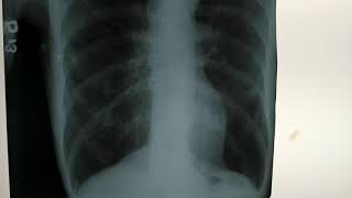 X Ray Chest COPD Emphysema  MBBS Final [upl. by Rory582]