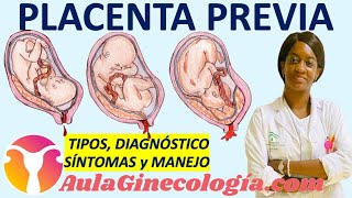 PLACENTA PREVIA CLASIFICACIÓN DIAGNÓSTICO 🩸SÍNTOMAS🩸 MANEJO  Ginecología y Obstetricia [upl. by Eytteb]