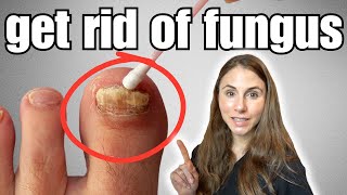 Get Rid Of Toenail Fungus With These 4 Easy Home Remedies [upl. by Alessandro270]