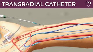 Transradial Catheter [upl. by Ecurb]