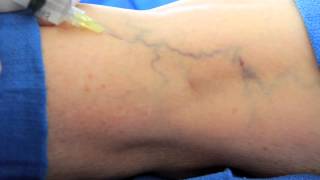 Surface Sclerotherapy at VēNA Clinic [upl. by Animsay]