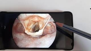 Anatomy of Laryngopharynx HypopharynxENT [upl. by Mechling]