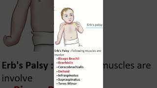 ErbDuchenne Palsy Insights into Upper Trunk Injuries of brachial plexus brachialplexusinjury [upl. by Cordi]