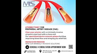 Clear Arterial Blockage With Atherectomy at MISS [upl. by Einned]