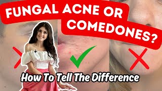 Fungal Acne VS Closed Comedones  Top 5  1 Practical Differences [upl. by Nivert]