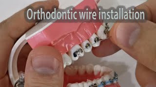 How to install amp ligate orthodontic wire with elastic ligature and ss twisted preformed ligature [upl. by Dlnaod954]