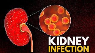 Kidney Infection Causes Signs and Symptoms Diagnosis and Treatment [upl. by Jacquetta]