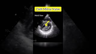 Cleft Mitral Valve Echocardiogram echocardiography mitral heart [upl. by Currey153]