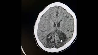 Bilateral chronic occipitoparietal infarctsDystrophic calcifications thickened adjacent calvarium [upl. by Ilime]