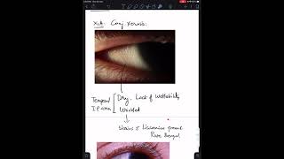 Case 7 Xerophthalmia Vitamin A Deficiency [upl. by Hanid]