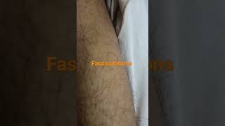 Fasciculation  muscle twitch shorts short shortvideo [upl. by Nayrbo]