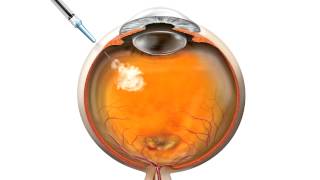 Anti VEGF Injection for macular degeneration [upl. by Burnie]