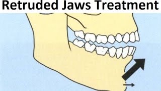 The Orthodontic Treatment of Retruded Backward Jaws Mandible with Tooth Extraction by Dr Mike Mew [upl. by Lesirg697]