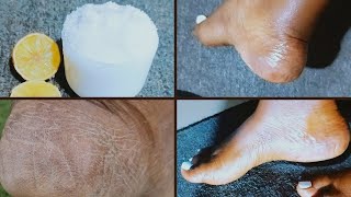 GET Rid of Dead Skin on your Feet FAST with Kitchen Ingredients [upl. by Aesoh903]