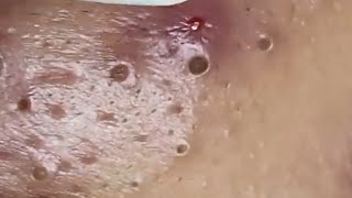 Blackheads amp Whiteheads Satisfying Removal 0104 [upl. by Nivrad]