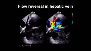 Echocardiography Essentials Spotting tricuspid and pulmonary valve disease [upl. by Ahsied]