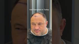 Hair Transplant in Turkey  Hair Transplant Process  Hair Transplant hairtransplant [upl. by Ahsikar25]