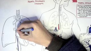 Liver Cirrhosis [upl. by Enyad80]