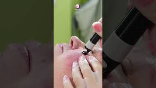 Skin Place Laser Telangiectasia Treatment [upl. by Pigeon578]