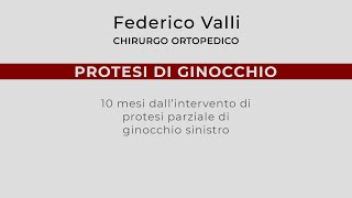 Protesi di Ginocchio 10 mesi dalloperazione di protesi parziale [upl. by Tiff]