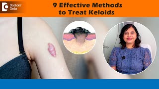 9 Methods to treat KELOIDS  Can KELOIDS be cured permanently Dr Amee Daxini  Doctors Circle [upl. by Lorraine543]