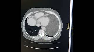 Mediastinal lipoma Mediastinal lipomatosis [upl. by Briano148]