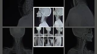 barium swallow xray 🍺🍺 [upl. by Gabbi708]