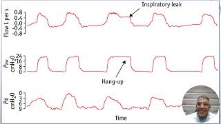 Monitoring In Acute NIV [upl. by Elledoj243]