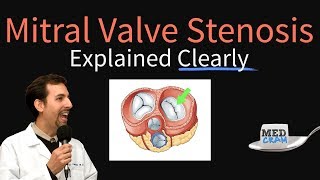 Mitral Valve Stenosis Explained Clearly  Pathophysiology Symptoms Treatment [upl. by Mcmaster]