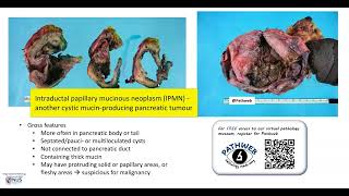 Pancreas Mucinous cystic neoplasm Gross pathology [upl. by Jonette]