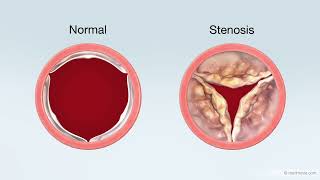 Transcatheter Aortic Valve Replacement TAVR Treatment for Aortic Stenosis [upl. by Llecrad]