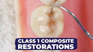 Class I Composite Restoration How to  Simple Vs Fancy Technique with Dr Lincoln Harris [upl. by Elliven695]