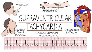 Understanding Supraventricular Tachycardia SVT [upl. by Nwahshar]