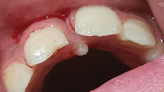 supernumerary tooth mesiodens  زوائد الاسنان [upl. by Fricke]