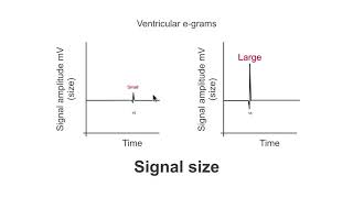 Pacemaker sensing and fixed sensitivity [upl. by Ferullo]