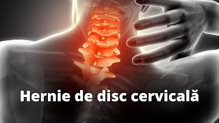 Ce este hernia de disc cervicală kinetoterapie durerecervicala [upl. by Mel357]