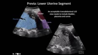 Ultrasound Diagnosis of Placenta Accreta A Tutorial for Imagers [upl. by Sorci]