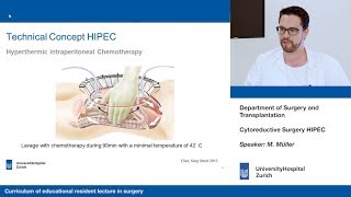 Cytoreductive Surgery HIPEC – Please participate in our 3minute survey below [upl. by Julienne]