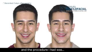 Jaw surgery Case  92 Rodrigo  Class II maxilomandibular biretrusion [upl. by Gerladina]