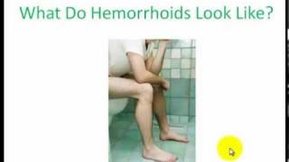 What Do Hemorrhoids Look Like  The Two Types Of Hemorrhoids Explained [upl. by Adivad378]