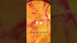 Diabetic retinopathy  Hemorrhages  proliferative diabetic retinopathy PDR  Short Video 182 [upl. by Edobalo]